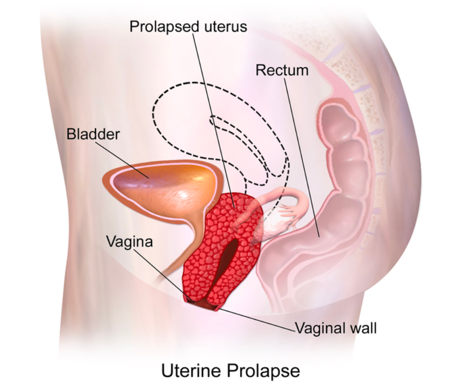 Prolapse Surgery for Pelvic Organ Prolapse