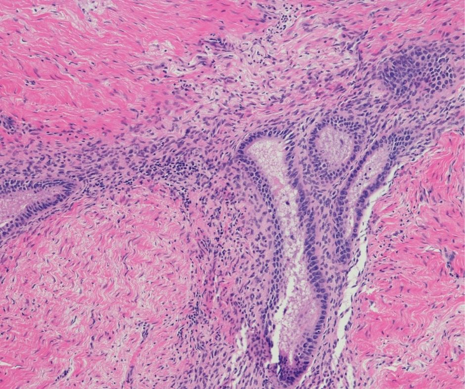 A micrograph scan showing endometriosis