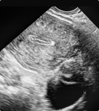 Ovarian Cysts & Pelvic Conditions